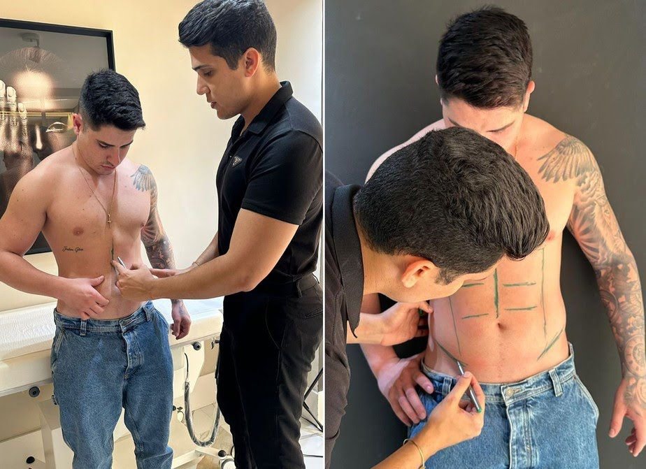 Lipo LAD: A Escolha dos Famosos para Definir o Corpo