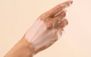 Pessoas com vitiligo ganham prioridade em consultas no SUS