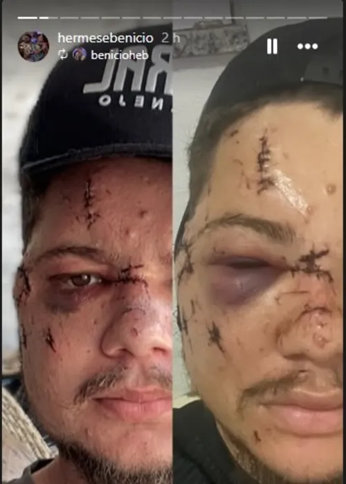 Cantor sertanejo fica com rosto desfigurado após ser agredido