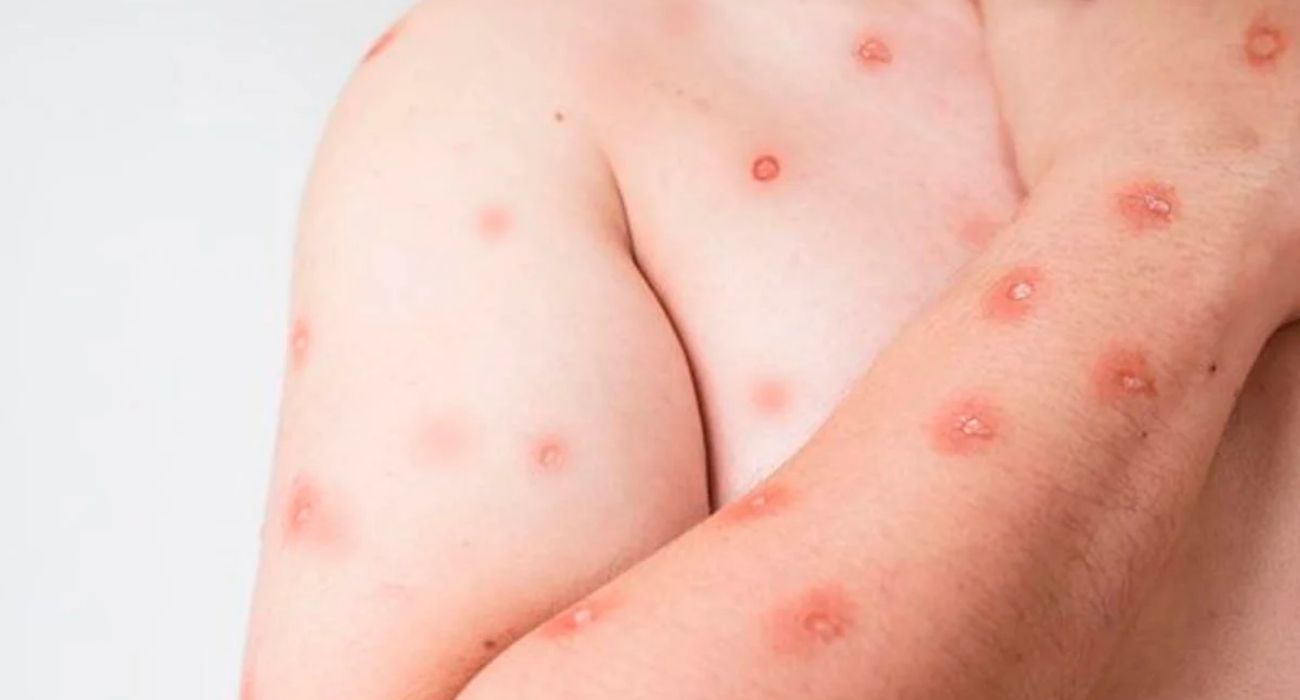 Lesões de pele características da mpox e atendimento médico em caso suspeito Lesões de pele características da mpox e atendimento médico em caso suspeito