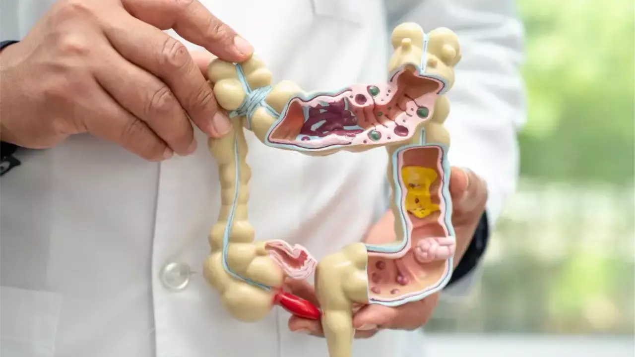 Ilustração médica do intestino grosso com área destacada para explicar sintomas e prevenção do câncer de intestino Ilustração médica do intestino grosso com área destacada para explicar sintomas e prevenção do câncer de intestino